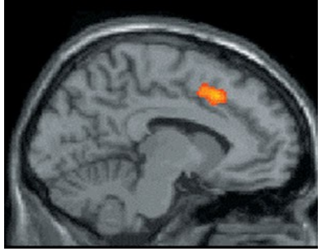 Brain scan showing orange anterior (frontal) cingulate gyrus