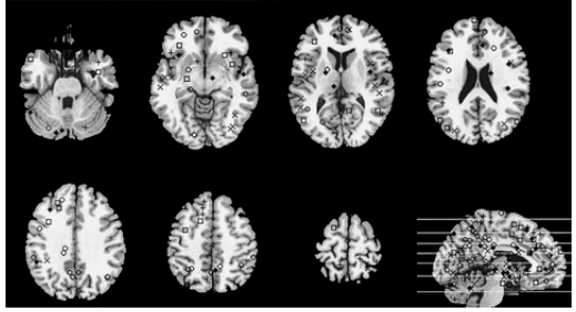 Black and white brain scans showing various activity